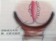 宮頸癌篩查沒那么簡單，這些技巧助你提高取樣質(zhì)量